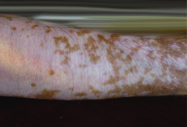 vitiligo